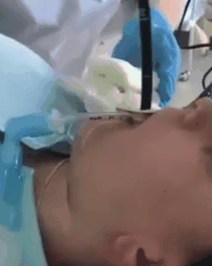 脊灰病毒|熟睡女子胃中取出蛇；非洲根除野生脊灰病毒；超加工食品加速端粒缩短