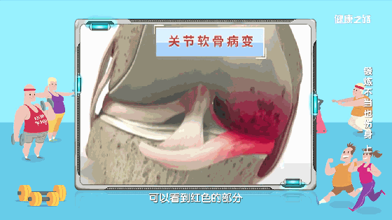 髋关节|越练越受伤！抡胳膊、倒着走、甩腿，这3种运动别做了！