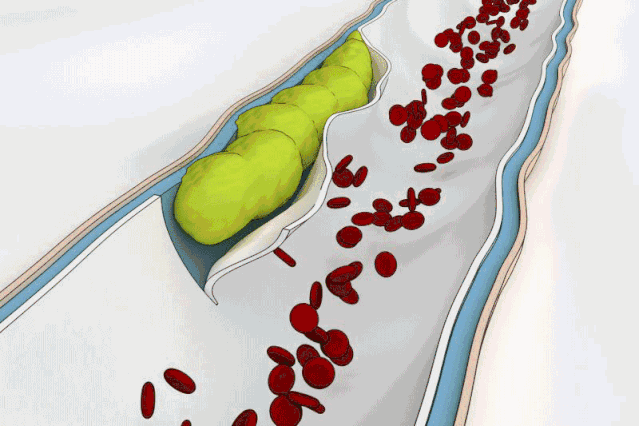 组织或是器官缺血坏死;而静脉内的血栓则可以引起血流瘀滞,引起组织