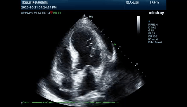 心脏不好,这项检查多半跑不了!戳文,了解最全面的超声心动检查
