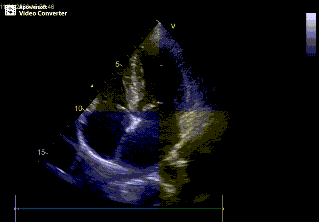 复查超声心动图,提示左室射血分数正常(ef 65%),二尖瓣轻中度反流,三