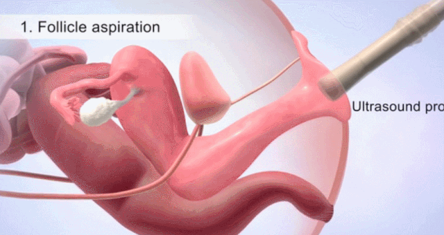 真实拍摄丨揭秘试管婴儿全过程看着都痛真的好心疼女人