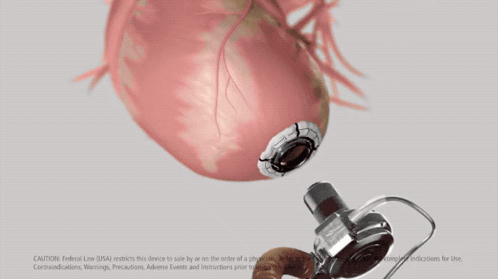 心脏|花 100 万买一颗人工心脏，不是让你活到 200 岁的