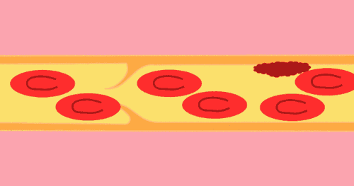 熬夜|男子熬夜打麻将后血栓跑进肺里？久坐突发胸闷需警惕！预防方法“一步到位”