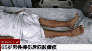 脊髓损伤|脊髓电刺激手术治疗脊髓损伤瘫痪