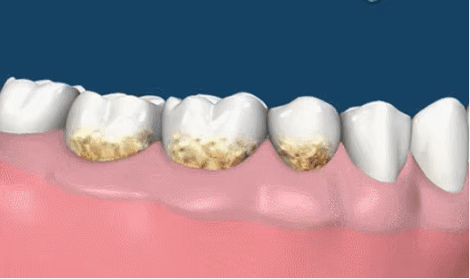 03口臭如果牙缝等口腔死角内长时间积存食物残渣,它们便会在细菌的