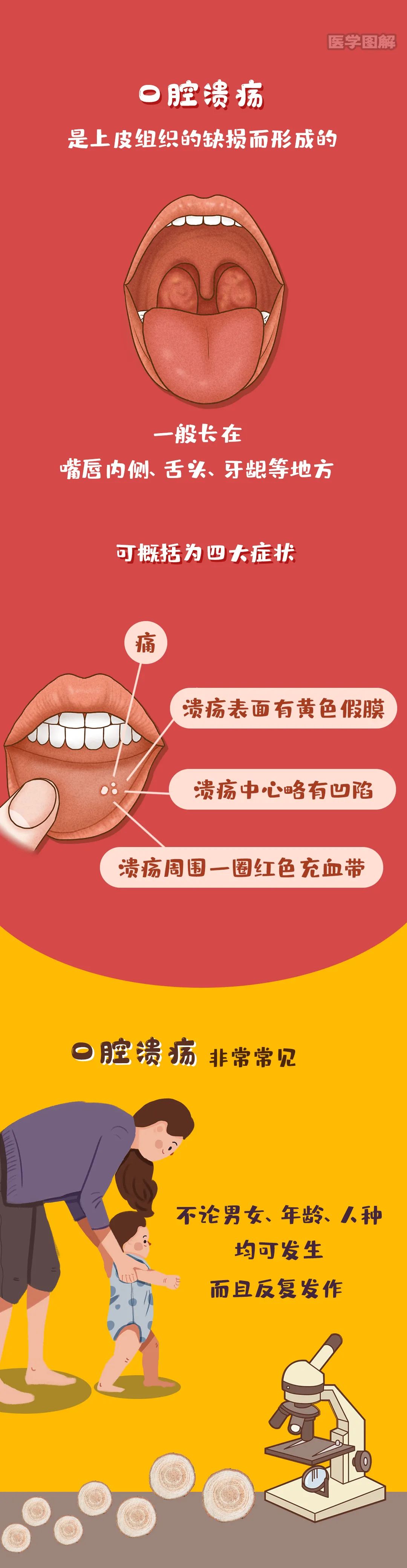 现代的口腔溃疡缺什么维生素的插图