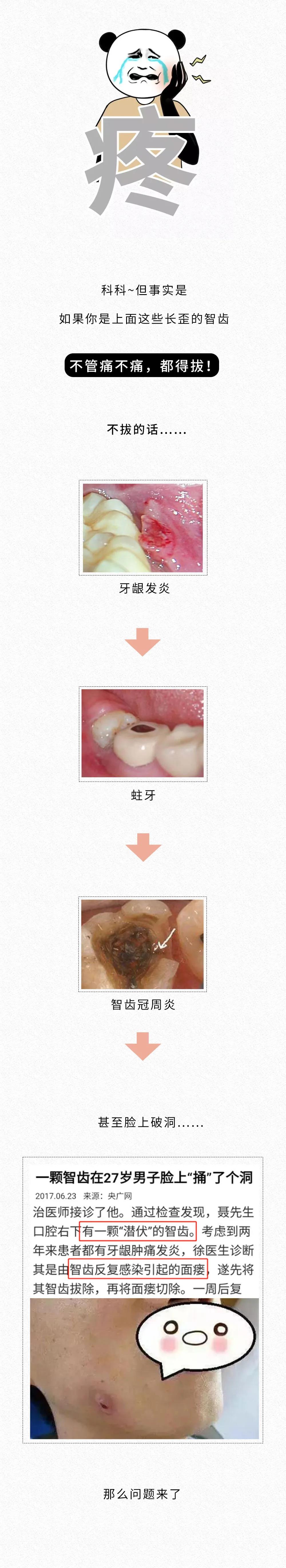 智齒忍著不拔,臉上會爛出個洞?