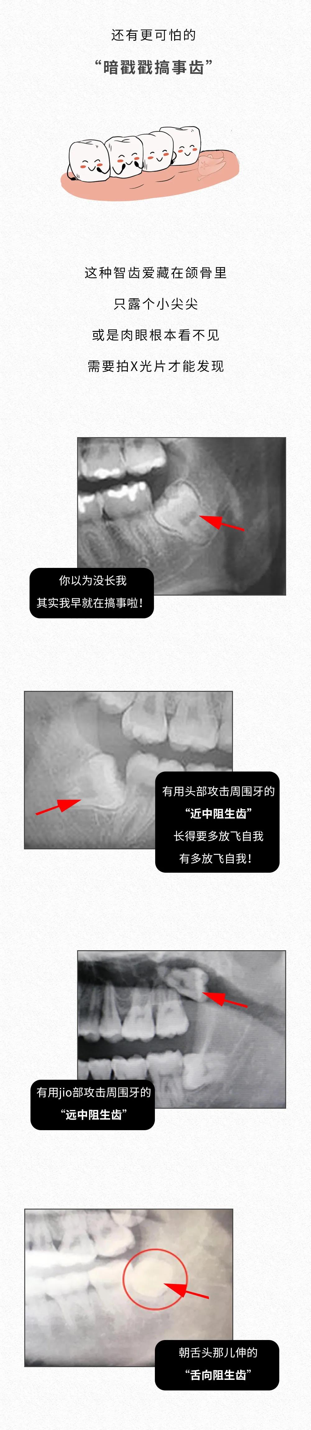 智齒忍著不拔,臉上會爛出個洞?