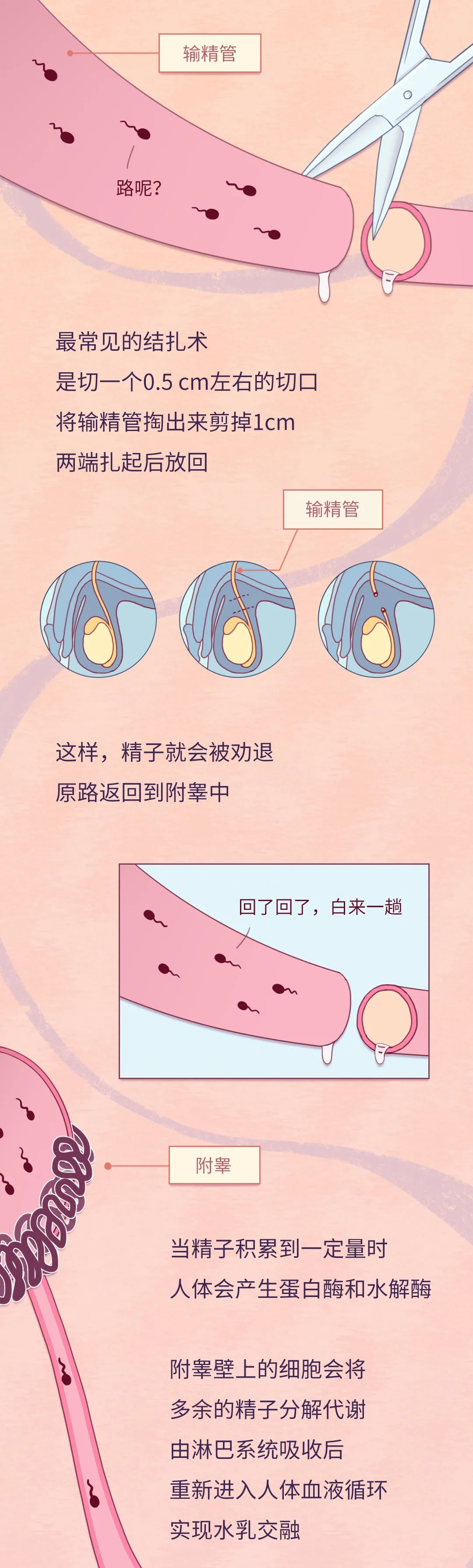 结扎之后,男人的精子都去哪了?