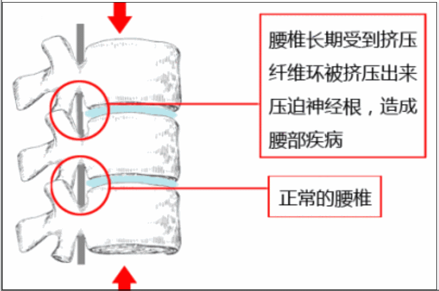 腰椎间盘没有突出到开刀的程度 怎么治 腾讯新闻