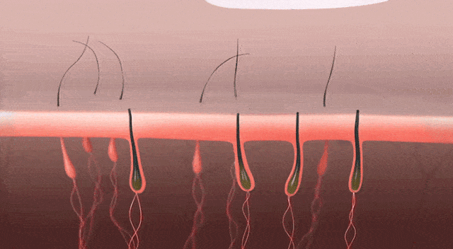 杭州光子嫩肤|不用化妆化妆就能轻松get"磨皮肌"