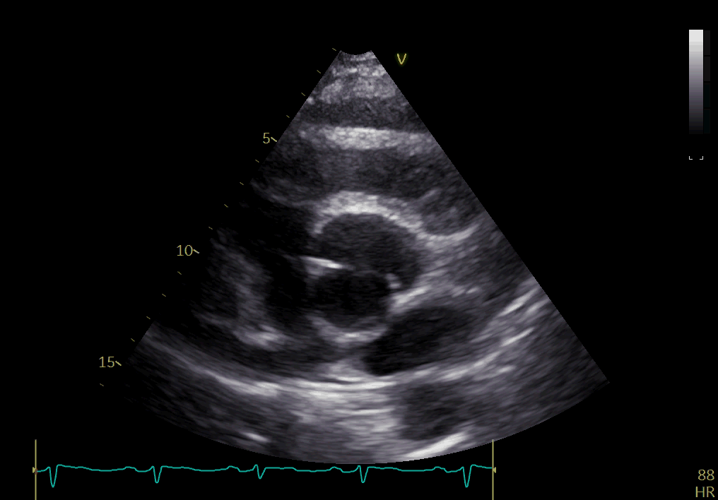 主动脉功能二叶瓣是什么意思?