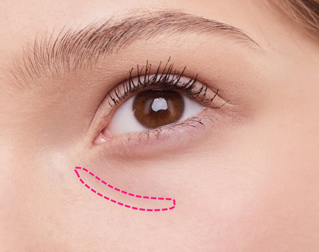 黑眼圈泪沟消失术年轻10岁的遮瑕秘诀超简单