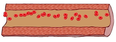 血管型的黑眼圈主要是青紫色,形成的原因有可能是天生皮肤角质比较薄