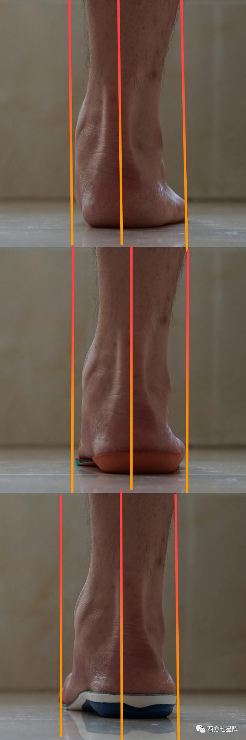 低足弓的烦恼,它来解决:sidasrunning足弓支撑鞋垫上脚体验
