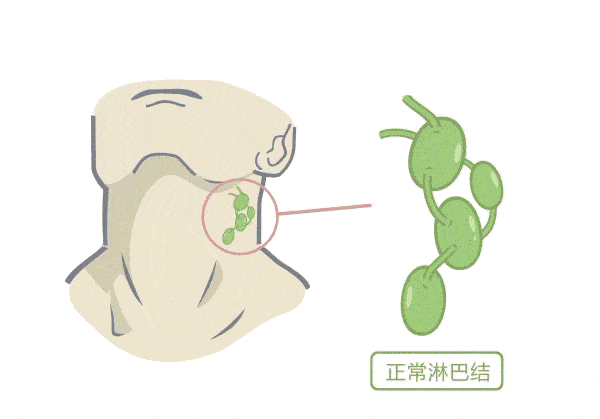颈部淋巴结肿大对身体有什么影响（颈部淋巴结肿大有危险吗）