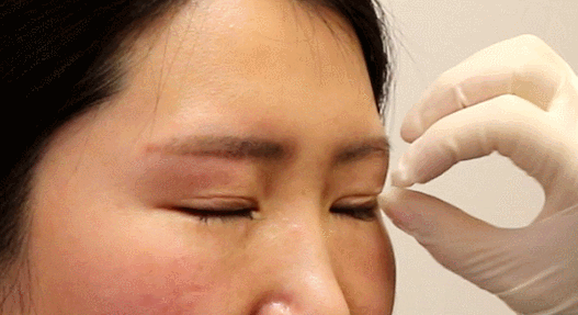 双眼皮修复中经常说到的粘连到底是什么要怎么修复