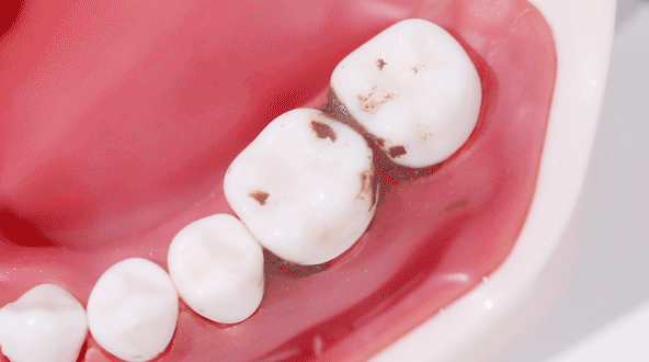 6mm标准水柱,能深入牙缝,口腔盲区,快速冲走食物残渣.