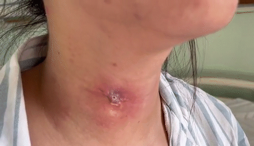 内蒙姑娘罹患怪病颈部多年漏水漏饭26年后确诊梨状窝瘘