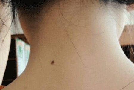 脖子后面有痣代表什么脖子后面有痣好不好