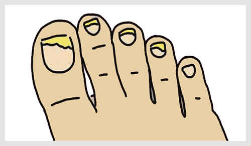 脚趾上长了一个"牡蛎"?每走一步都像被人用钳子狠狠夹了一下!