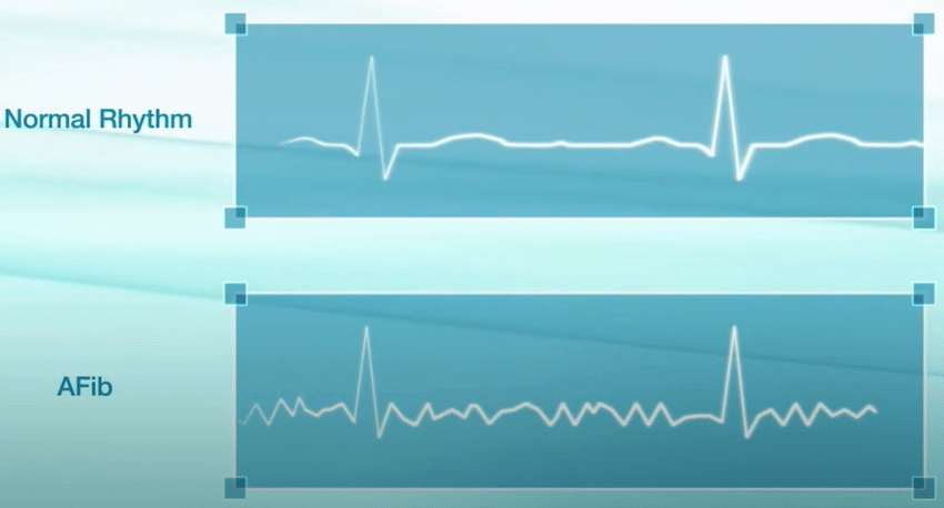 apple watch 心脏检测再升级,手腕上的它真的靠谱吗?