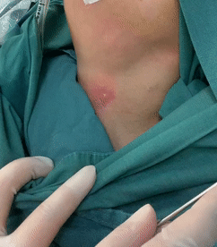 豆蔻年华却因颈部脓肿频繁手术来院细查终于探究真因