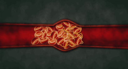 总觉得累,可能是血管里藏着"微血栓"