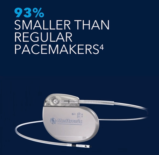 micra无线起搏器的尺寸设计仅有维生素胶囊般大小,体积比传统的心脏