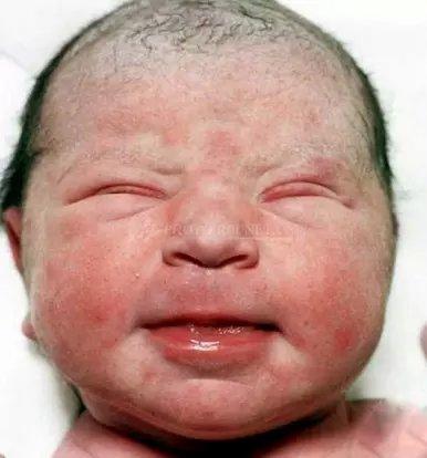 宝宝一出生满脸粪便,全身发黑,让医护人员作呕