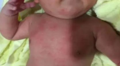 3个月宝宝全身长红点,查明真相后,婆婆狠狠抽