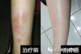 山东聊城李芳:饱受结节性红斑困扰 3 年,是西京