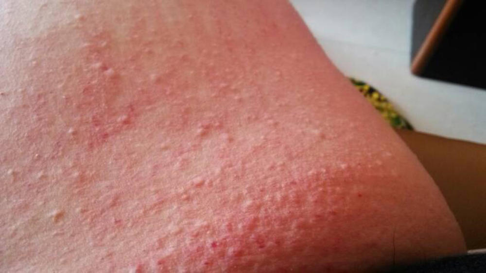 荨麻疹患者天天用醋加它擦身上,3天后身体发生