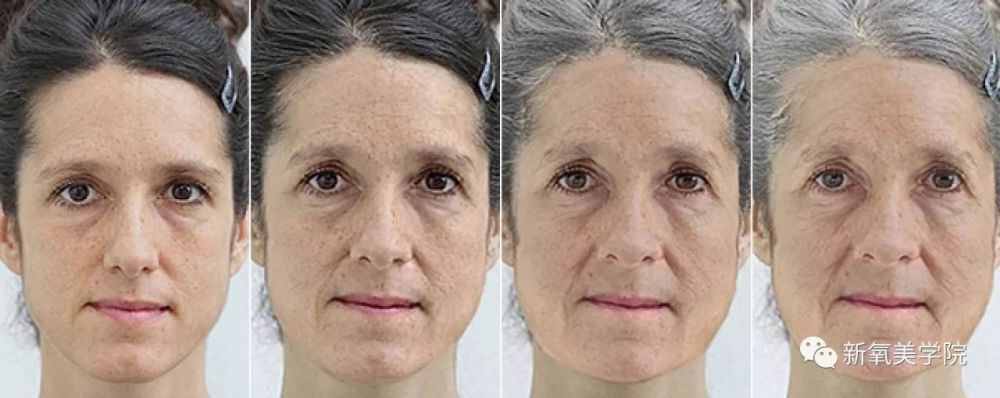 一个人在衰老的进程里,鼻子的梨状孔会随着年龄的增大不断的凹陷(下图