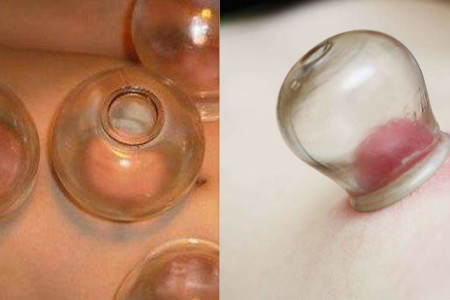 肚子拔罐减肥示意图 拔火罐位置要准确