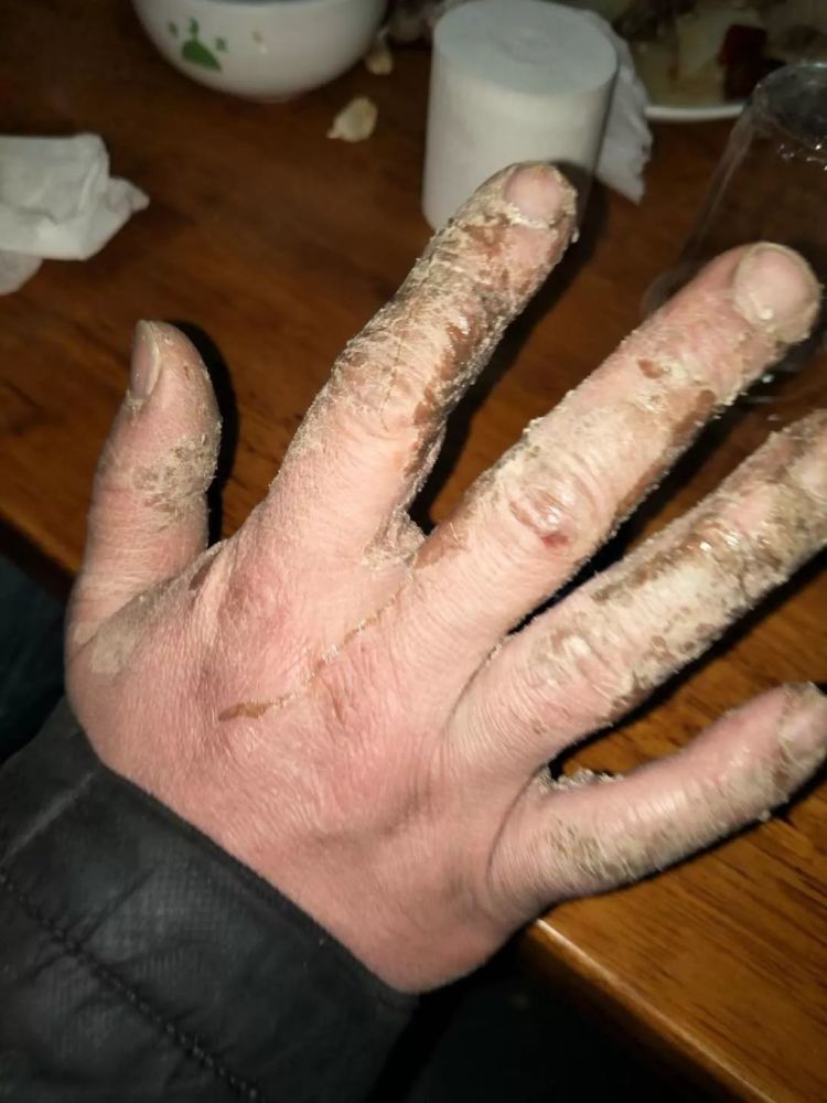 平顶山男子的这只手粗糙不堪却红遍朋友圈