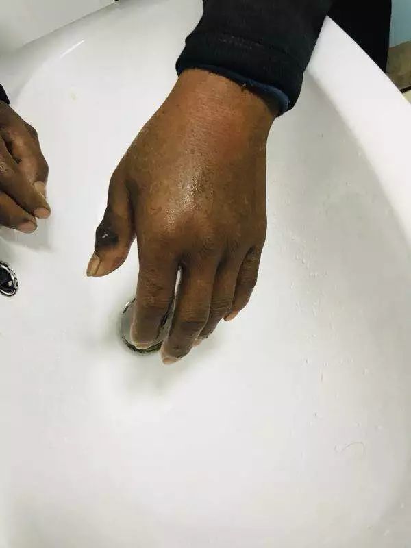 男子被眼镜蛇咬伤手指发黑险丧命