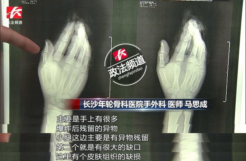 娄底12岁男孩火药装饮料罐制"鞭炮" 全身多处被炸伤-腾讯网