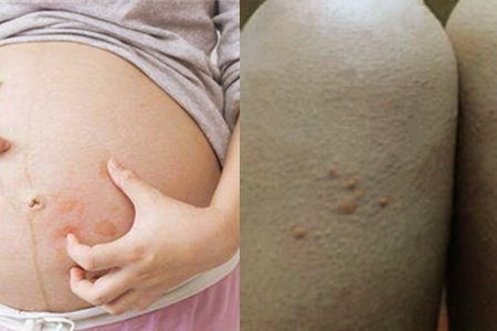 治疗孕妇荨麻疹止痒的偏方 快速缓解皮肤瘙痒