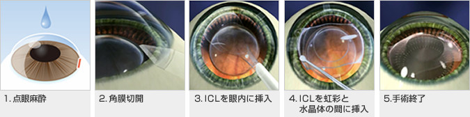 近视手术 除了激光 还可以装个晶体 腾讯网