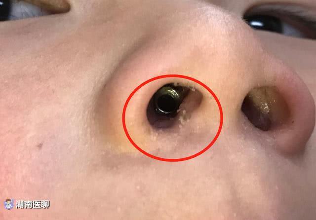 长沙一男童鼻塞以为感冒妈妈发现他鼻孔闪光