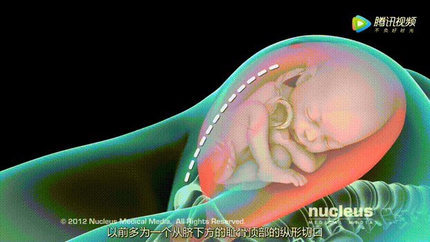 进入腹腔之后,摸一下子宫,确定胎儿位置之后,切开小口,把羊膜囊夹破