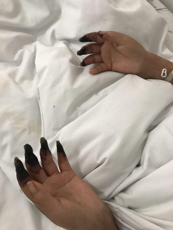 女子手指蹭破小口致八根手指变黑成枯树枝