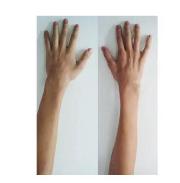 少年手部无力别轻视警惕平山病