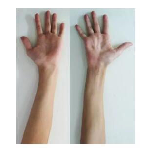 可见患侧(图中右侧)手掌大鱼际,小鱼际,骨间肌以及前臂肌肉明显萎缩需