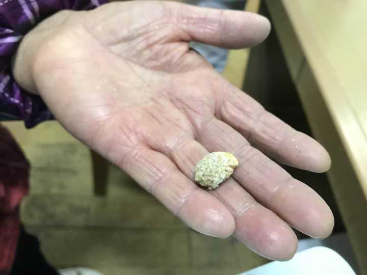 大妈喉咙胀痛10多年竟因藏着罕见的大石头