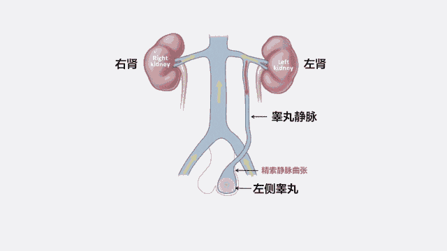 (2)静脉壁及邻近的结缔组织薄弱或提睾肌发育不全,削弱了精索内静脉