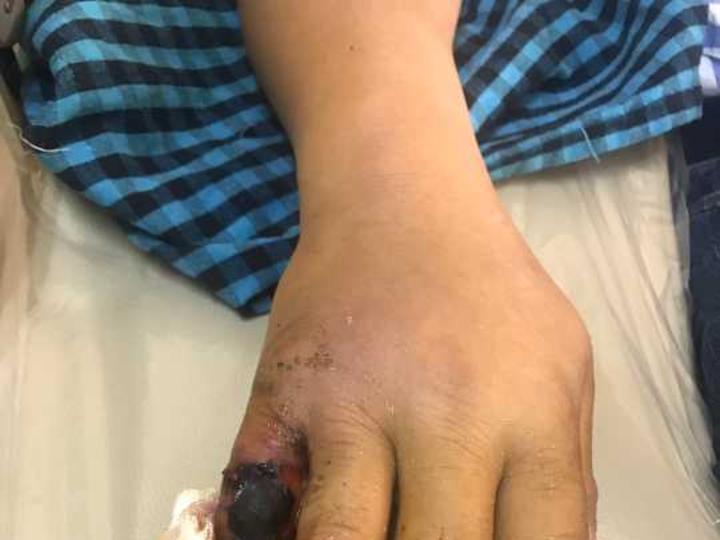 男子挖笋被五步蛇咬伤小拇指可能保不住