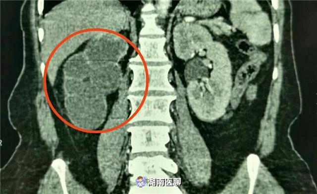 湖南51岁大妈反复腰痛10年不当事,结果右肾被